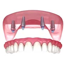Denture Stabilisation