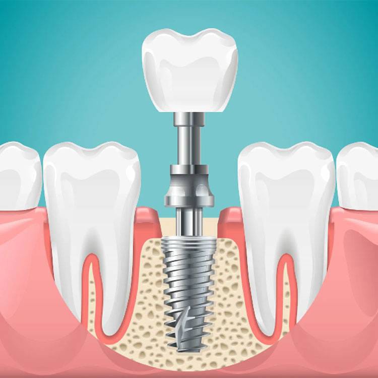 Dental Implants