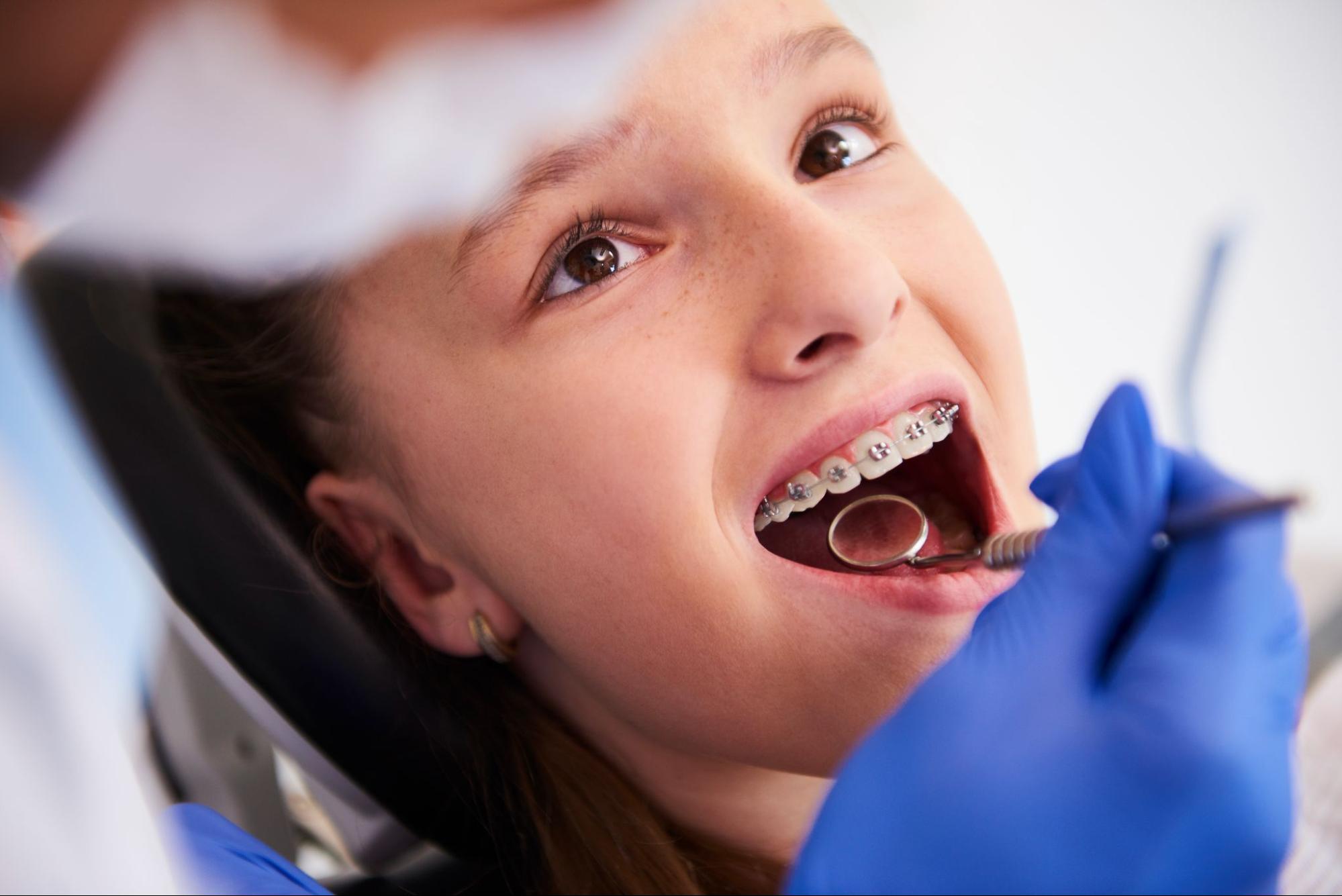 Braces Procedures