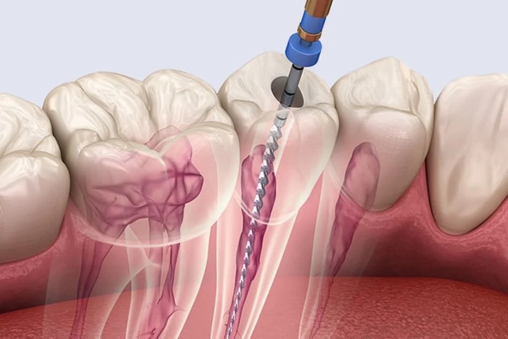 Rotary Root Canal